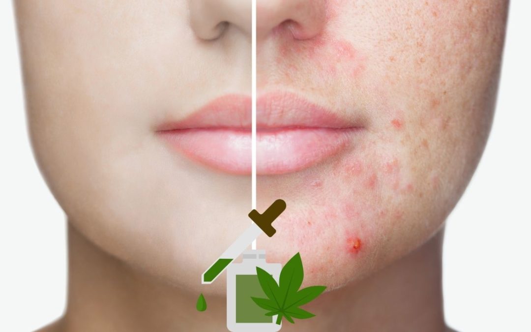 Trattamento CBD dell'acne prima e dopo
